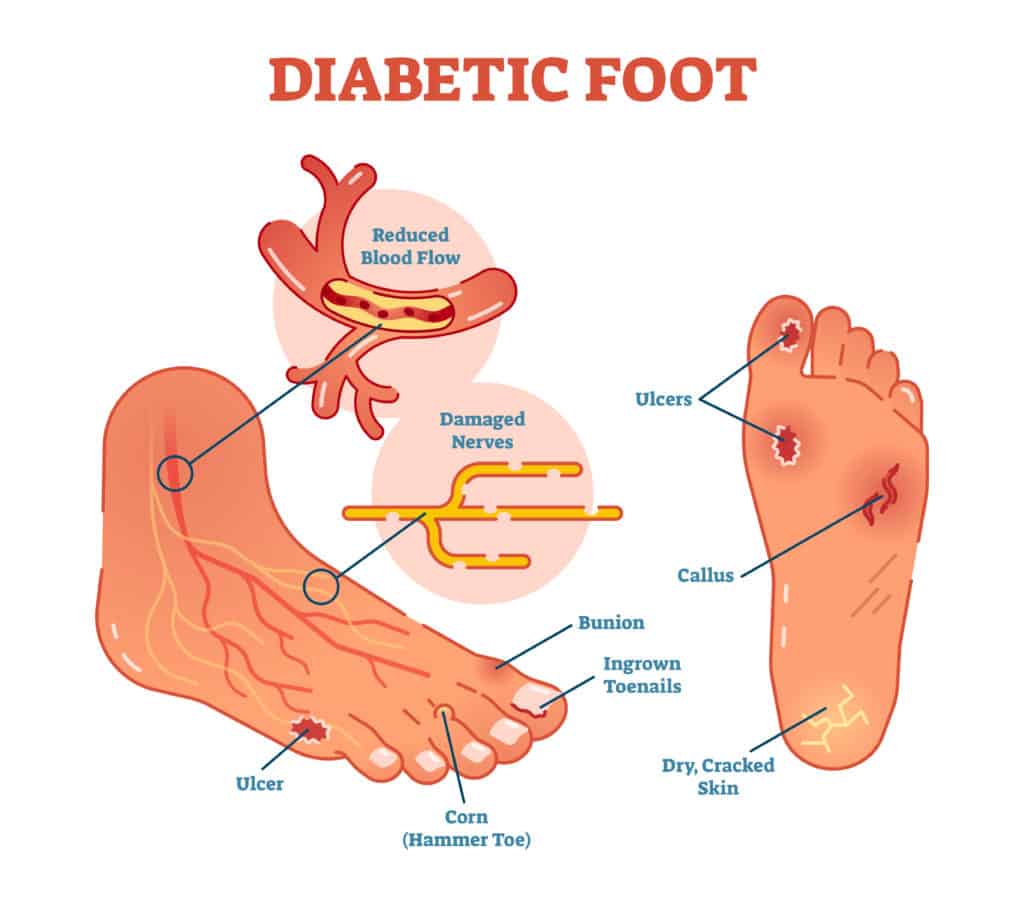 diabetic foot issue