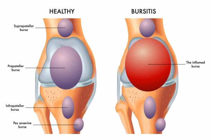 bursitis knees