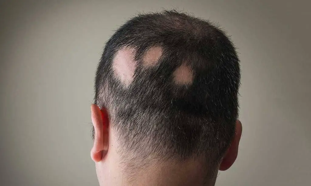 Alopecia