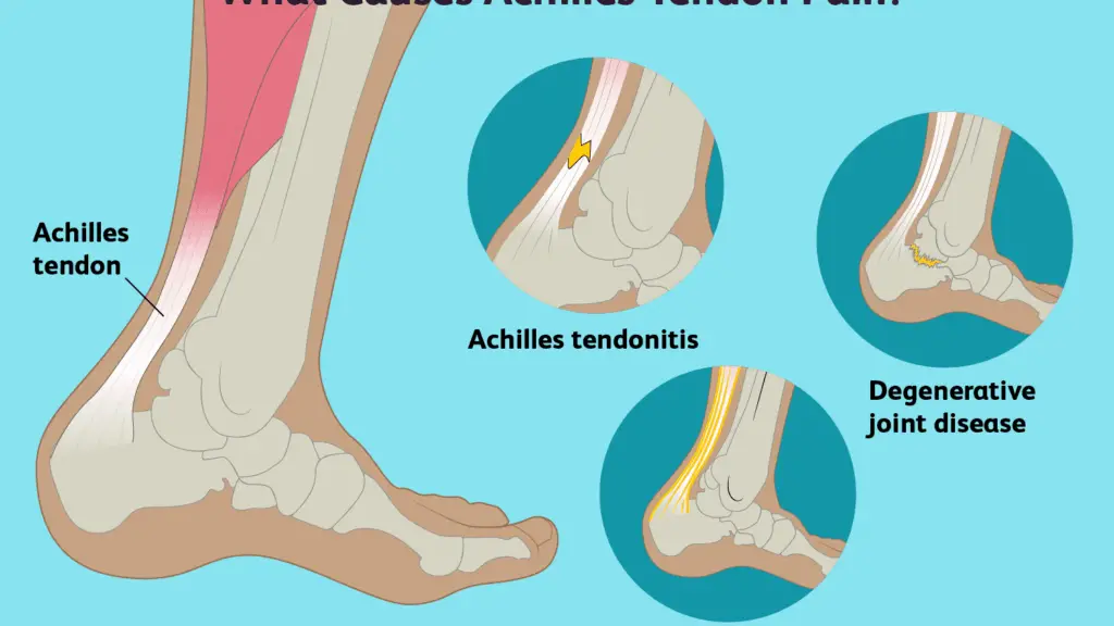 Achilles Tendonitis